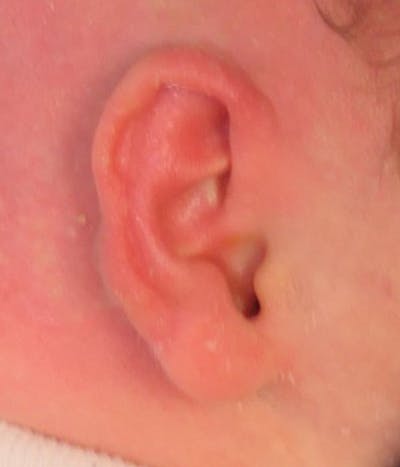 Ear Molding Before & After Gallery - Patient 365852 - Image 2