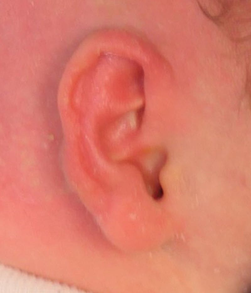 Ear Molding Before & After Gallery - Patient 365852 - Image 2