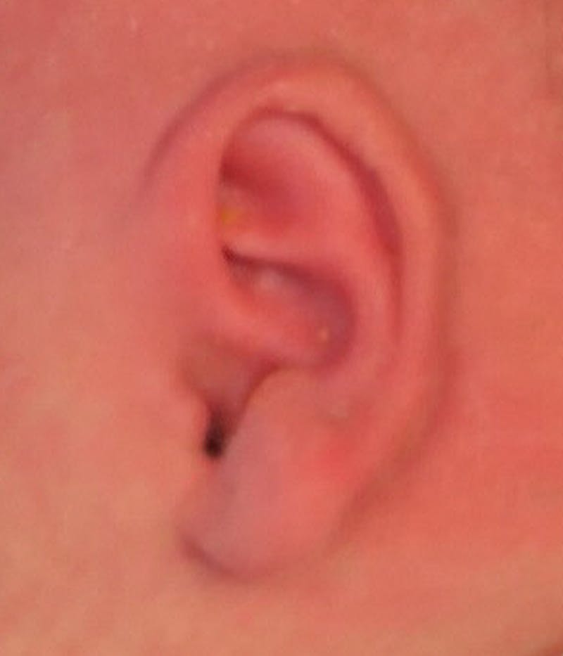 Ear Molding Before & After Gallery - Patient 365852 - Image 4