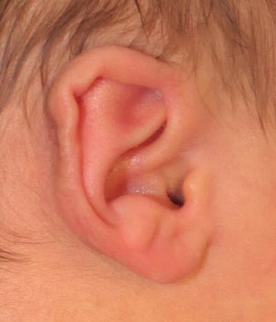 Ear Molding Before & After Gallery - Patient 181105 - Image 1