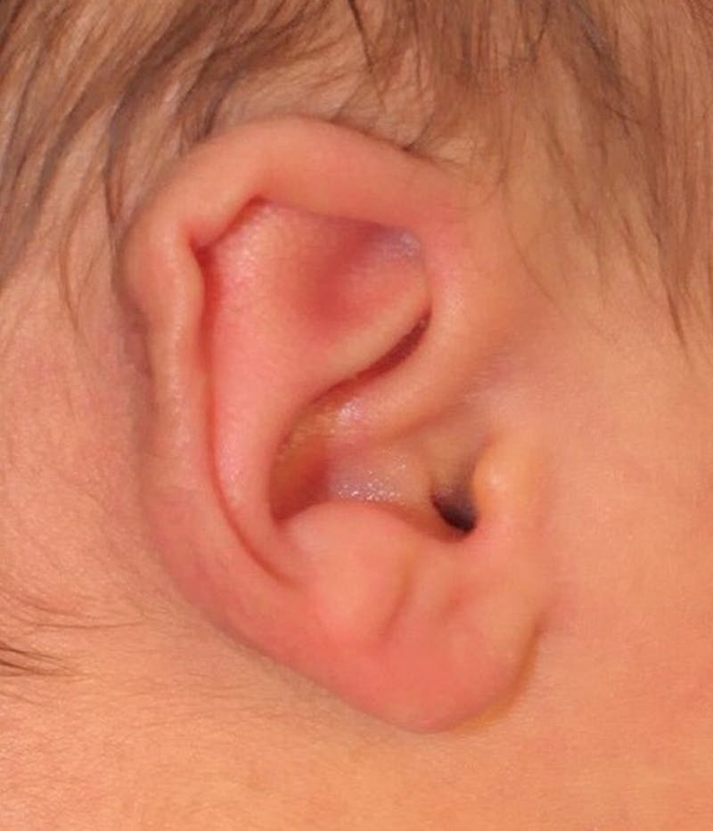 Ear Molding Before & After Gallery - Patient 181105 - Image 1