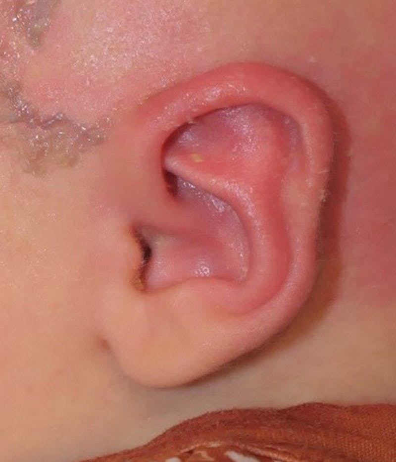 Ear Molding Before & After Gallery - Patient 181105 - Image 4