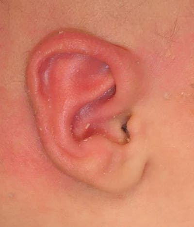 Ear Molding Before & After Gallery - Patient 181105 - Image 2