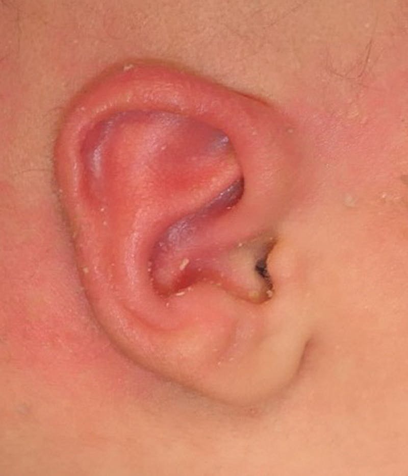 Ear Molding Before & After Gallery - Patient 181105 - Image 2