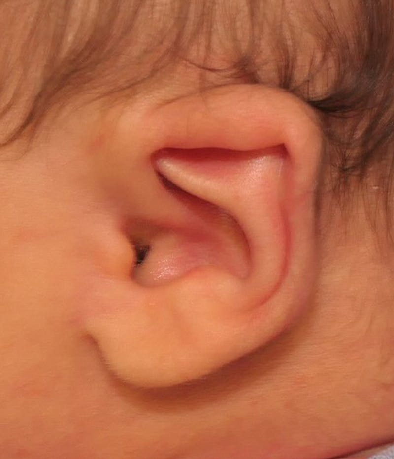 Ear Molding Before & After Gallery - Patient 181105 - Image 3