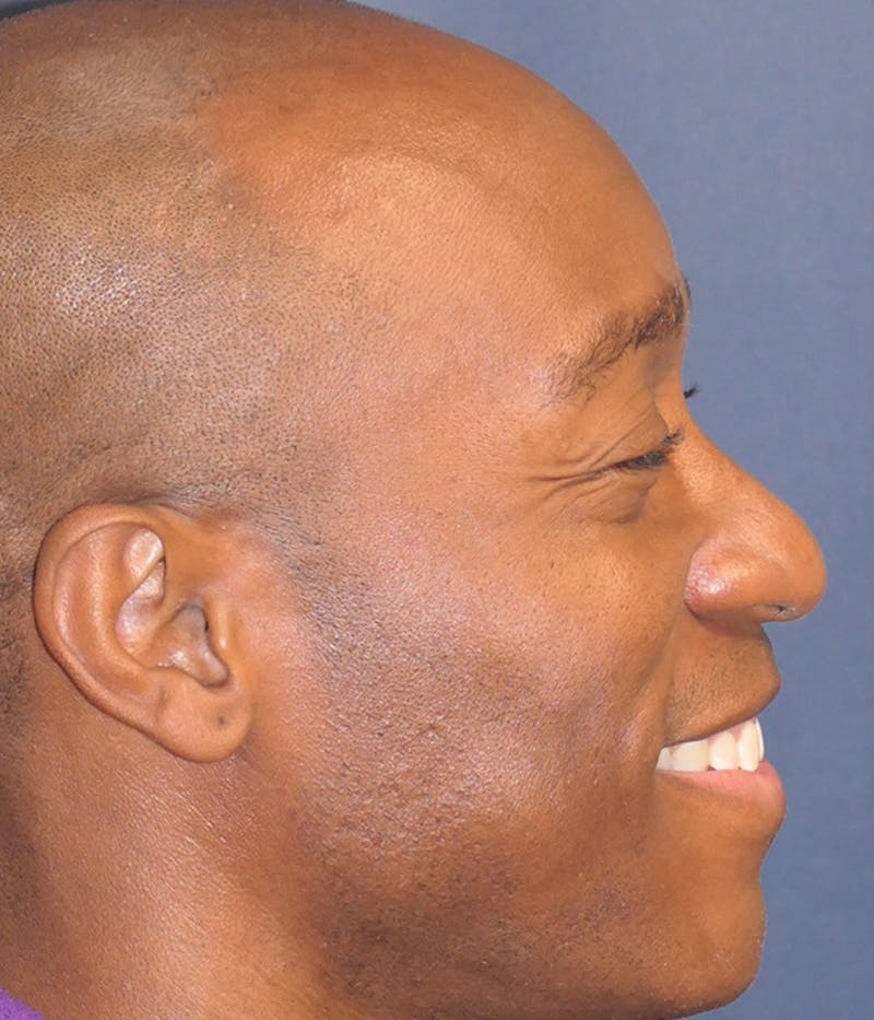 Rhinoplasty Before & After Gallery - Patient 953048 - Image 13