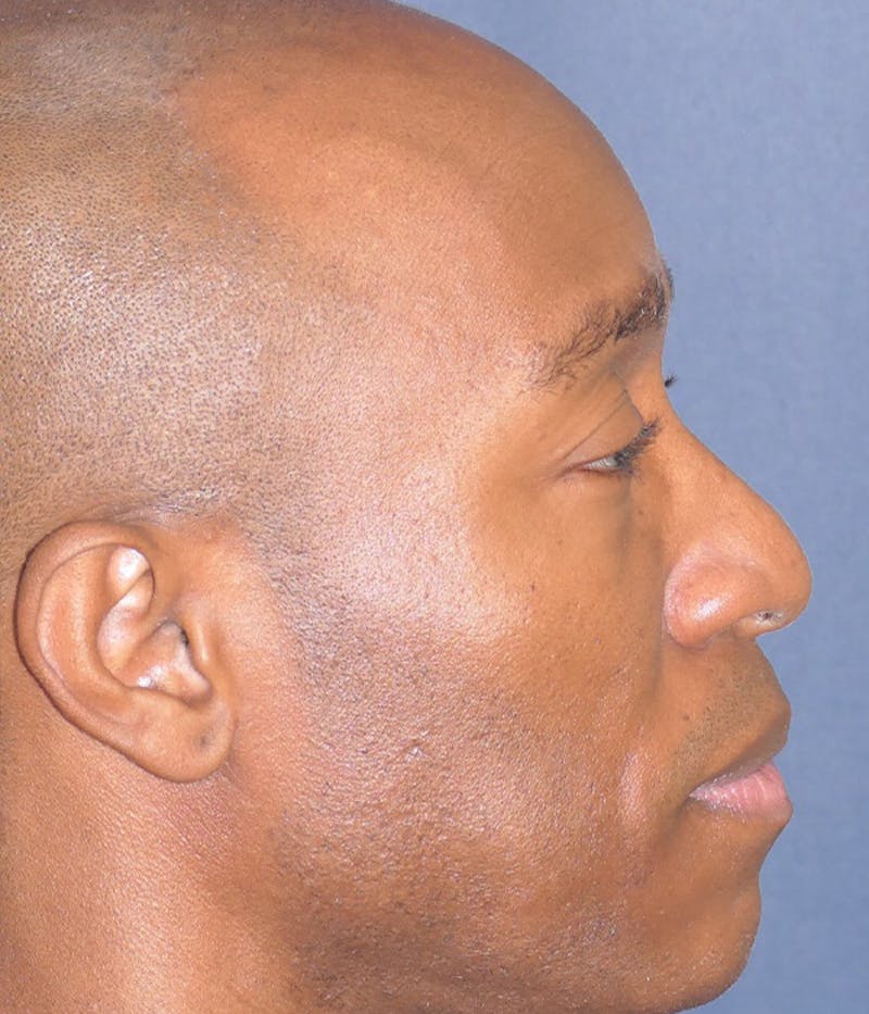 Rhinoplasty Before & After Gallery - Patient 953048 - Image 7
