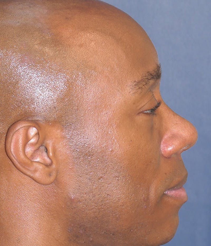 Rhinoplasty Before & After Gallery - Patient 953048 - Image 8