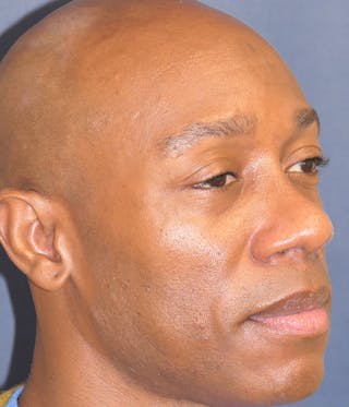 Rhinoplasty Before & After Gallery - Patient 953048 - Image 6