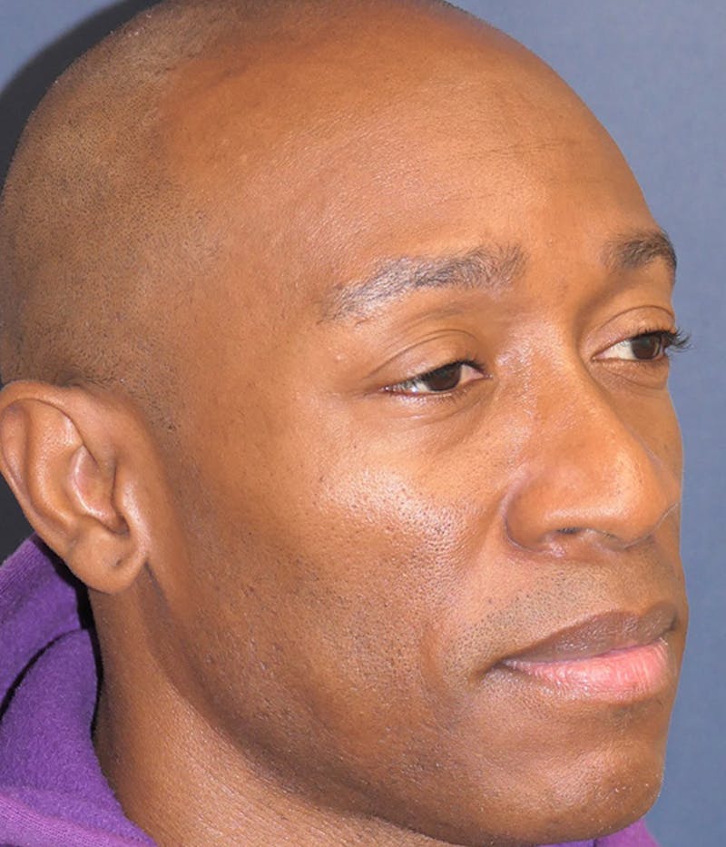 Rhinoplasty Before & After Gallery - Patient 953048 - Image 5