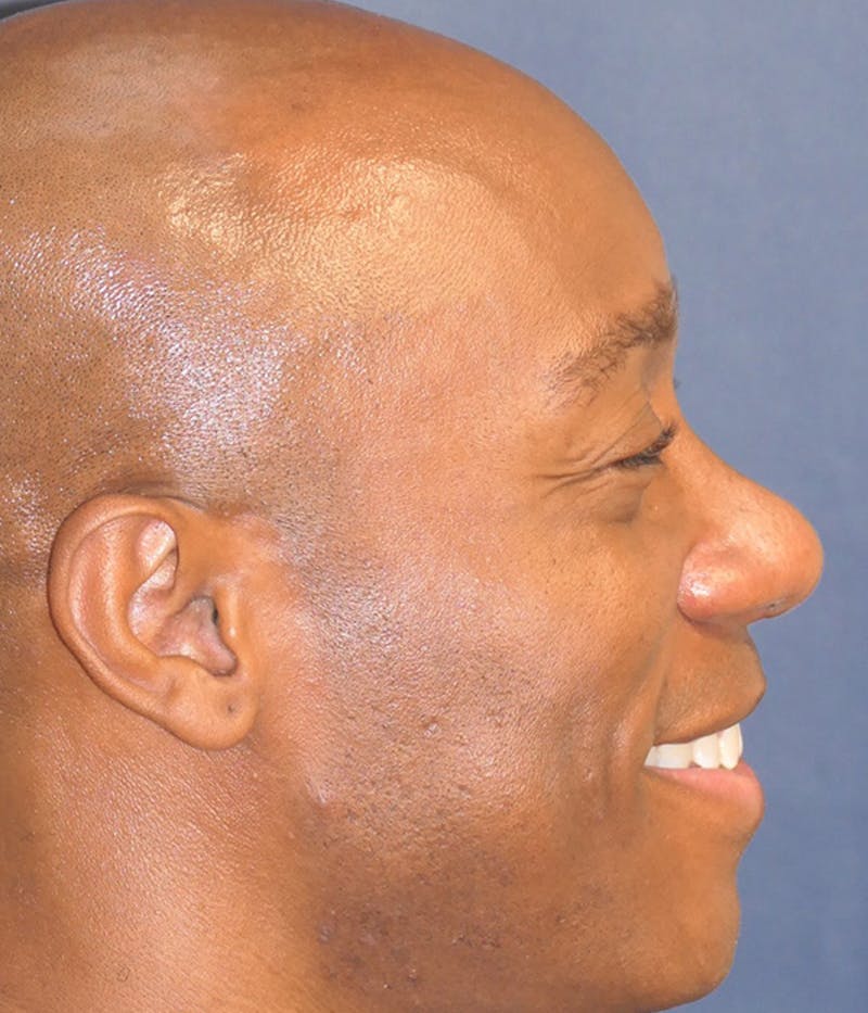 Rhinoplasty Before & After Gallery - Patient 953048 - Image 14