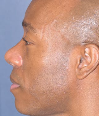 Rhinoplasty Before & After Gallery - Patient 953048 - Image 12
