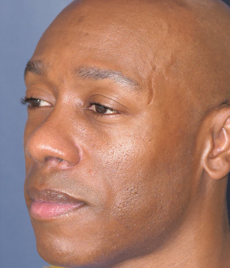 Rhinoplasty Before & After Gallery - Patient 953048 - Image 10