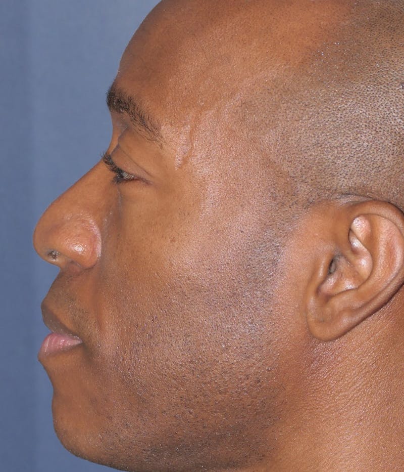 Rhinoplasty Before & After Gallery - Patient 953048 - Image 11