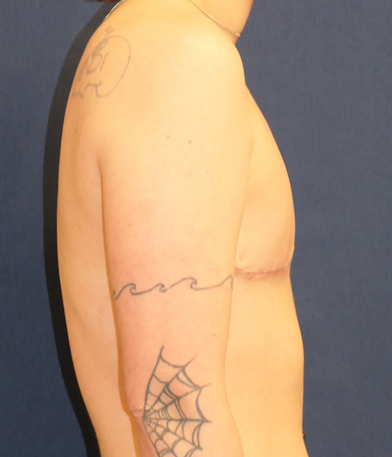 Masculinizing Surgery Before & After Gallery - Patient 266484 - Image 4