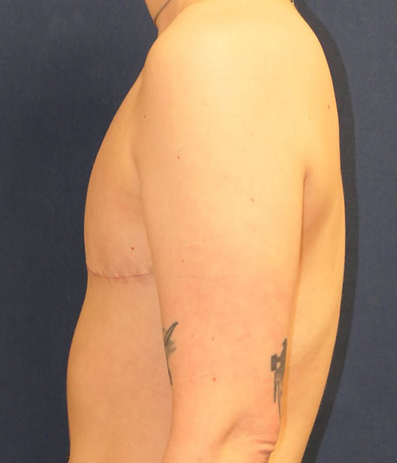Masculinizing Surgery Before & After Gallery - Patient 266484 - Image 6
