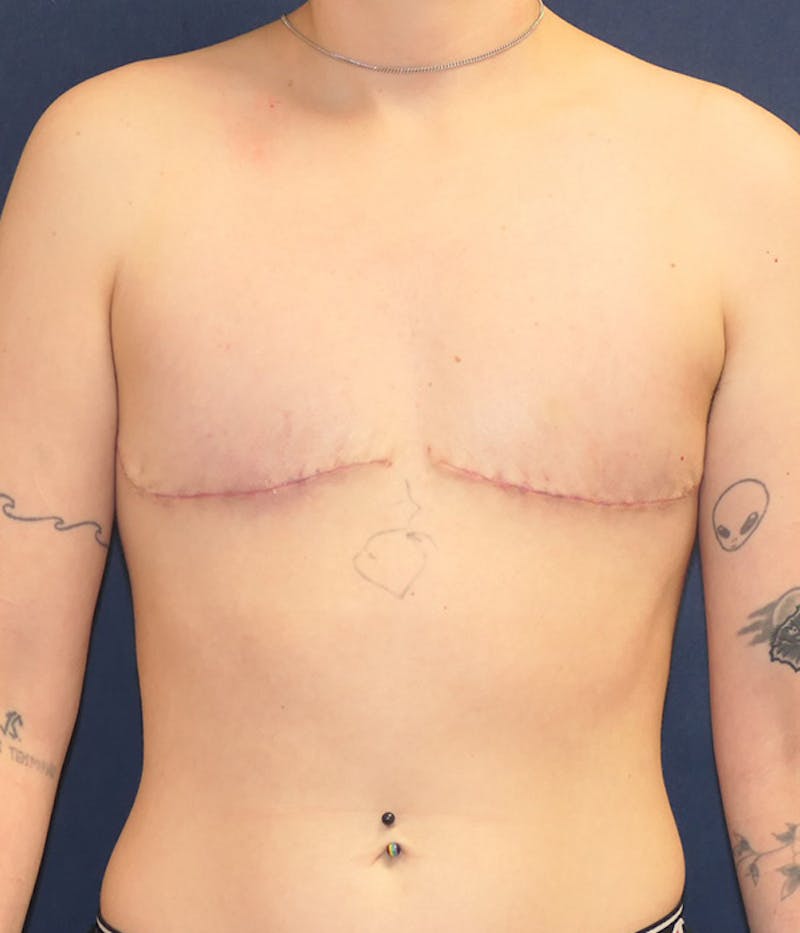 Masculinizing Surgery Before & After Gallery - Patient 266484 - Image 2