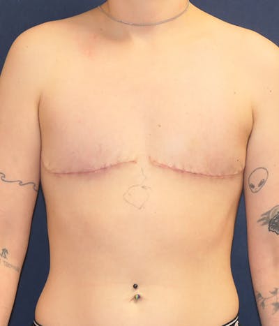 Masculinizing Surgery Before & After Gallery - Patient 266484 - Image 2