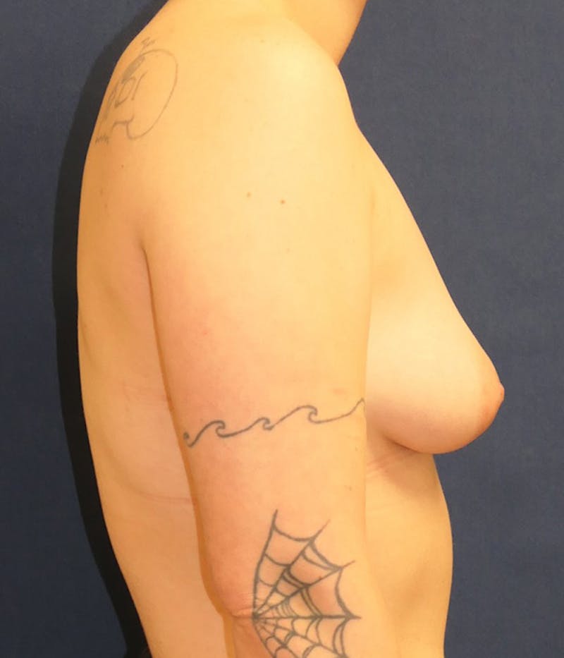 Masculinizing Surgery Before & After Gallery - Patient 266484 - Image 3