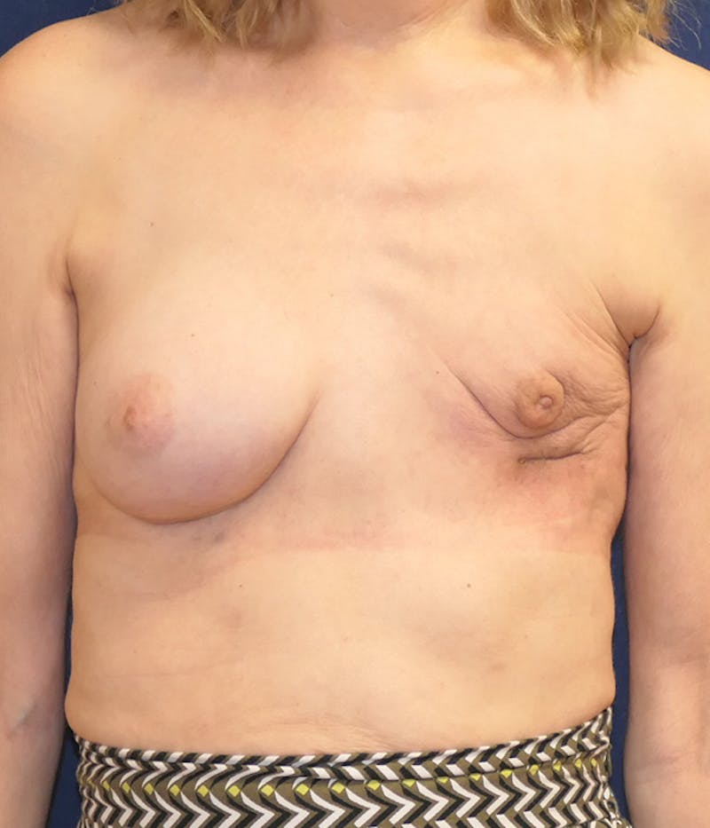 Breast Reconstruction with Autologous Tissue Before & After Gallery - Patient 832405 - Image 1