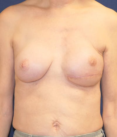 Breast Reconstruction with Autologous Tissue Before & After Gallery - Patient 832405 - Image 2