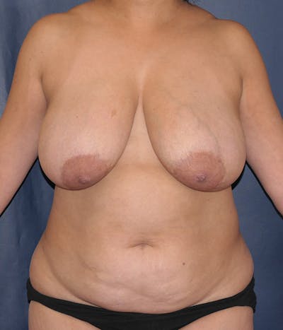 Liposuction Before & After Gallery - Patient 323477 - Image 1