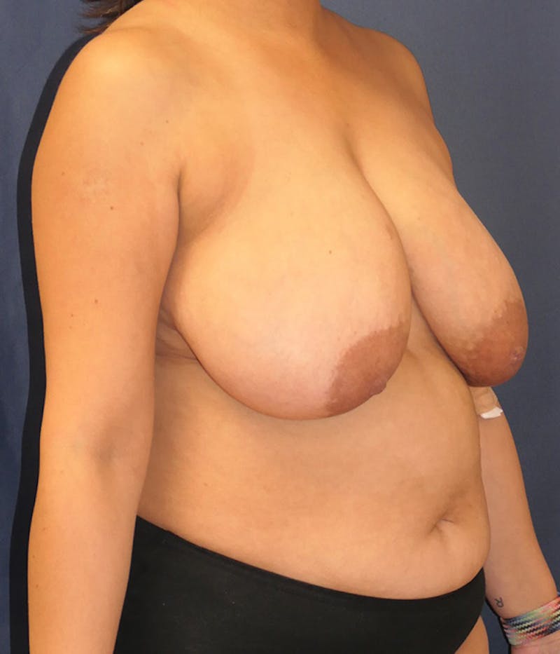 Liposuction Before & After Gallery - Patient 323477 - Image 3
