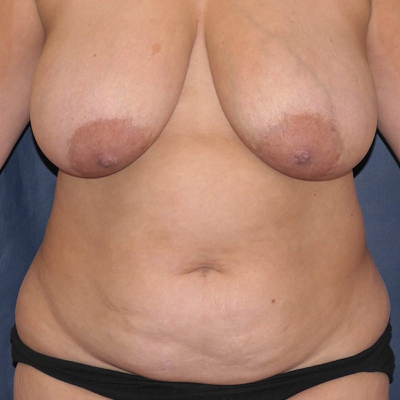 Tummy Tuck (Abdominoplasty) Before & After Gallery - Patient 633977 - Image 1