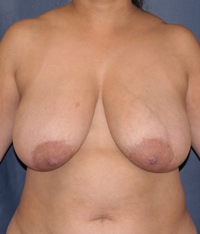 Breast Lift Before & After Gallery - Patient 322666 - Image 1
