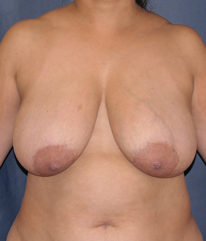 Breast Lift Before & After Gallery - Patient 322666 - Image 1