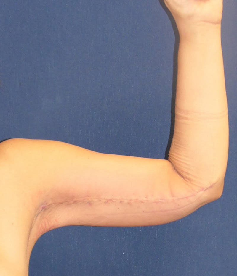 Arm Lift (Brachioplasty) Before & After Gallery - Patient 196419 - Image 8