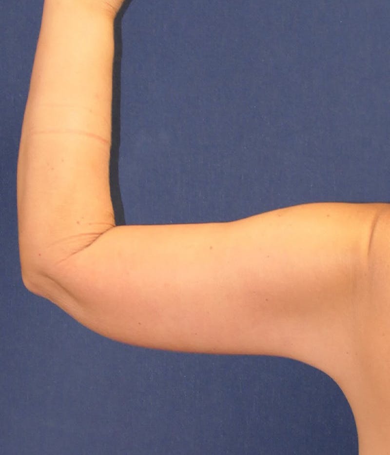 Arm Lift (Brachioplasty) Before & After Gallery - Patient 196419 - Image 6