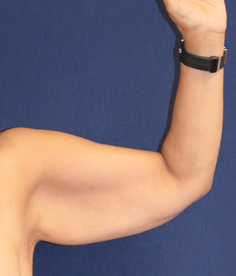 Arm Lift (Brachioplasty) Before & After Gallery - Patient 196419 - Image 7