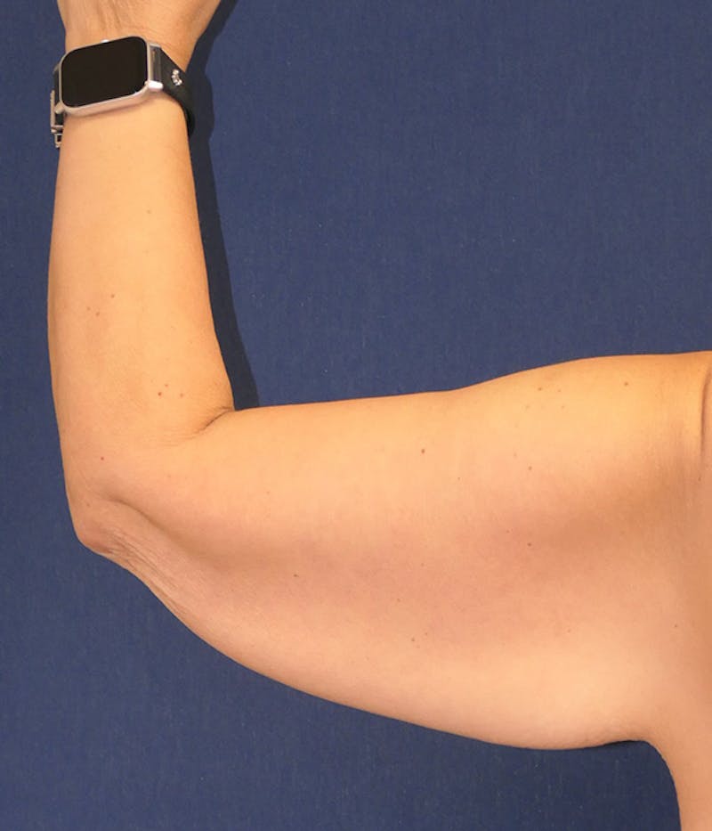 Arm Lift (Brachioplasty) Before & After Gallery - Patient 196419 - Image 5