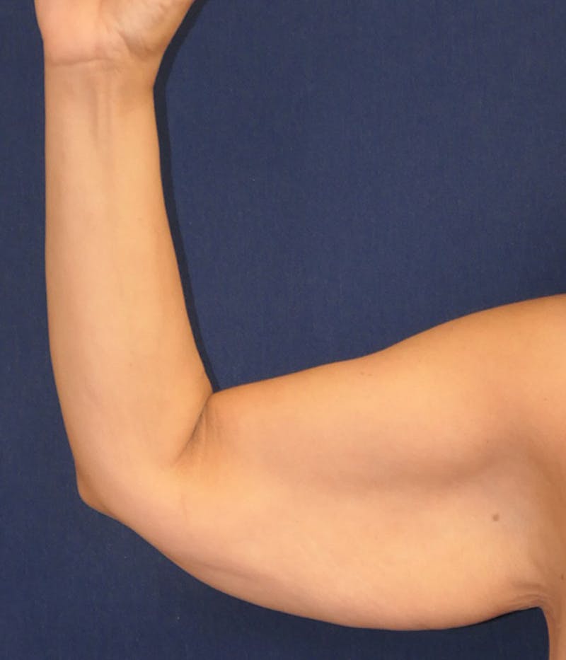 Arm Lift (Brachioplasty) Before & After Gallery - Patient 196419 - Image 1