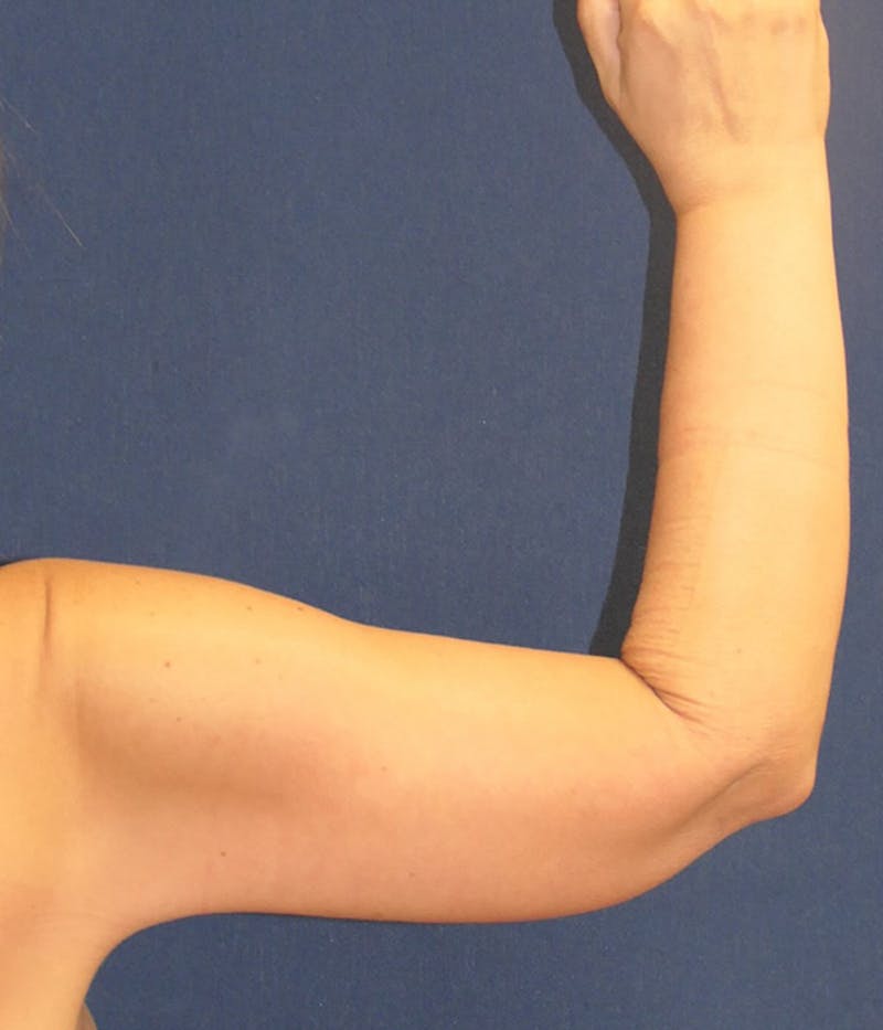 Arm Lift (Brachioplasty) Before & After Gallery - Patient 196419 - Image 4