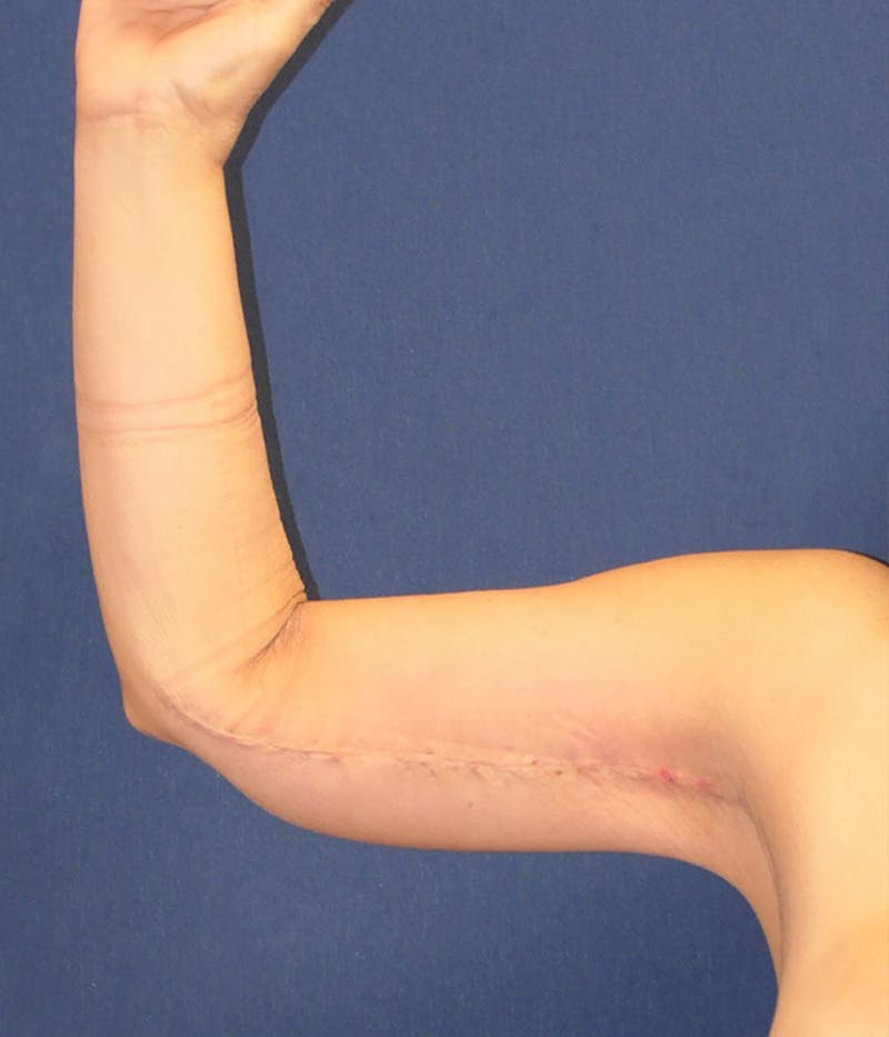 Arm Lift (Brachioplasty) Before & After Gallery - Patient 196419 - Image 2