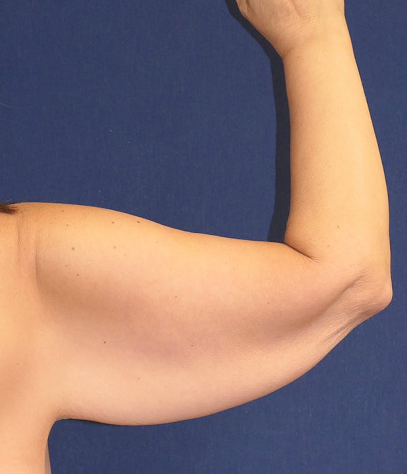 Arm Lift (Brachioplasty) Before & After Gallery - Patient 196419 - Image 3