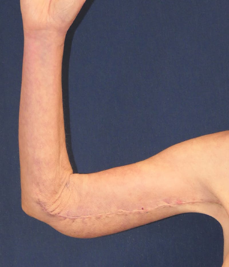 Arm Lift (Brachioplasty) Before & After Gallery - Patient 938175 - Image 8