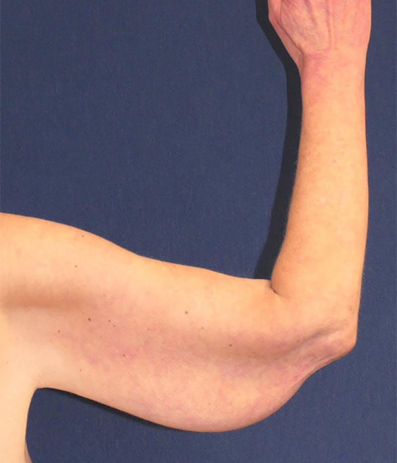 Arm Lift (Brachioplasty) Before & After Gallery - Patient 938175 - Image 1