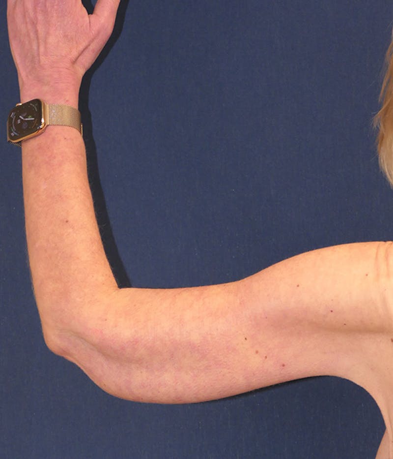 Arm Lift (Brachioplasty) Before & After Gallery - Patient 938175 - Image 6