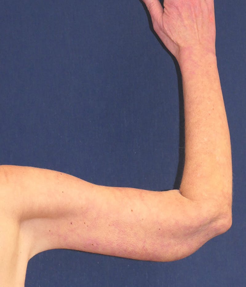 Arm Lift (Brachioplasty) Before & After Gallery - Patient 938175 - Image 2