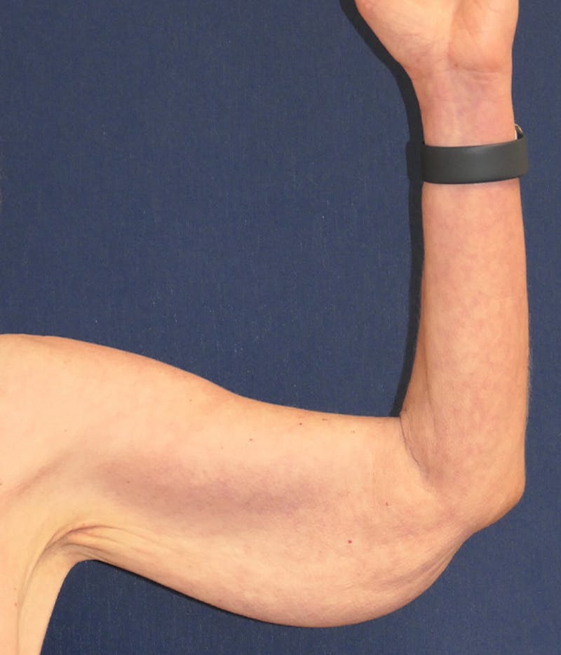 Arm Lift (Brachioplasty) Before & After Gallery - Patient 938175 - Image 3