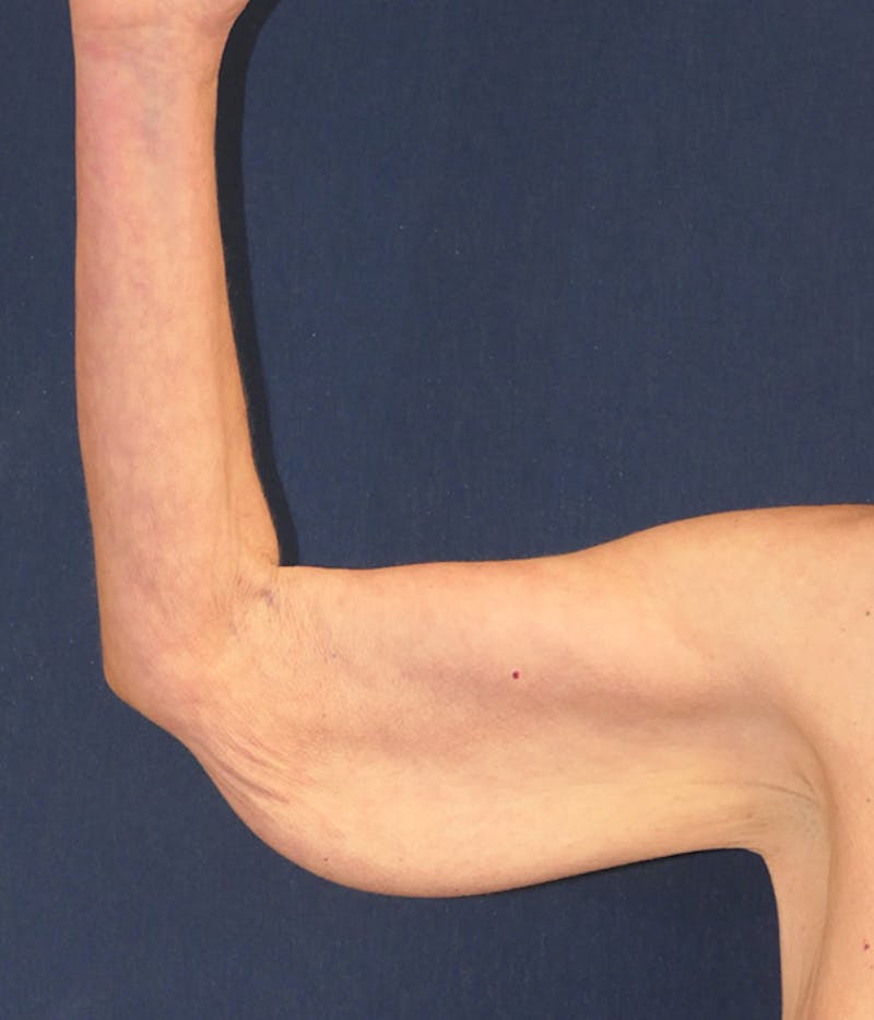 Arm Lift (Brachioplasty) Before & After Gallery - Patient 938175 - Image 7