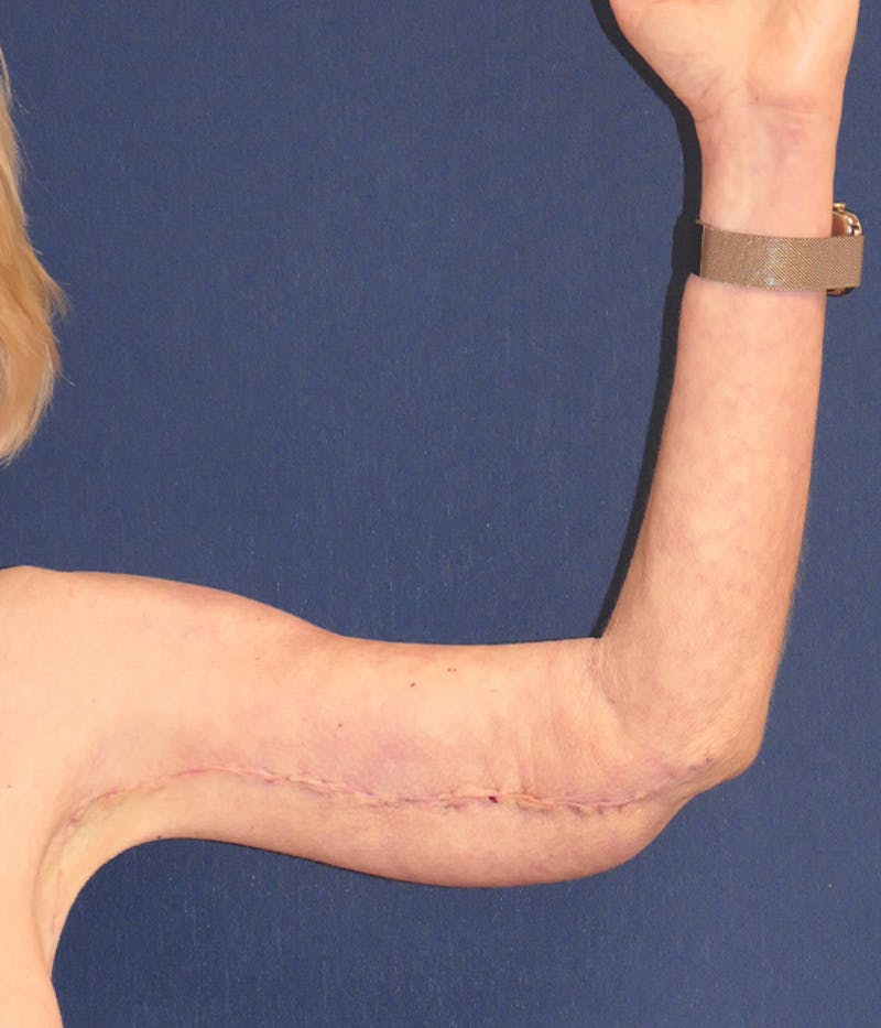 Arm Lift (Brachioplasty) Before & After Gallery - Patient 938175 - Image 4