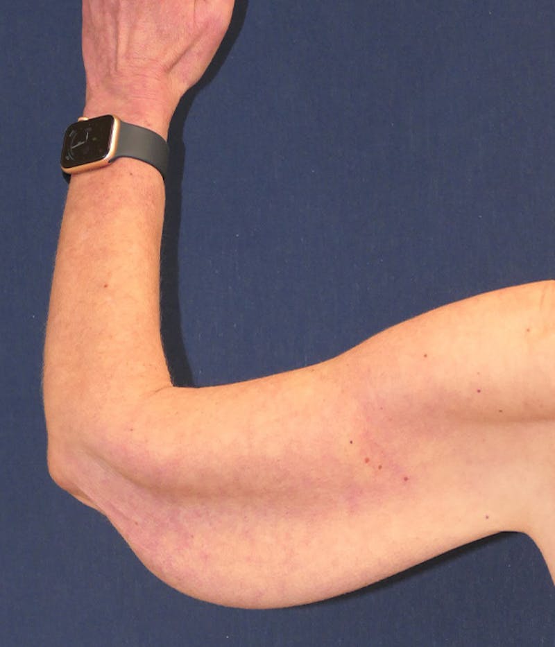 Arm Lift (Brachioplasty) Before & After Gallery - Patient 938175 - Image 5
