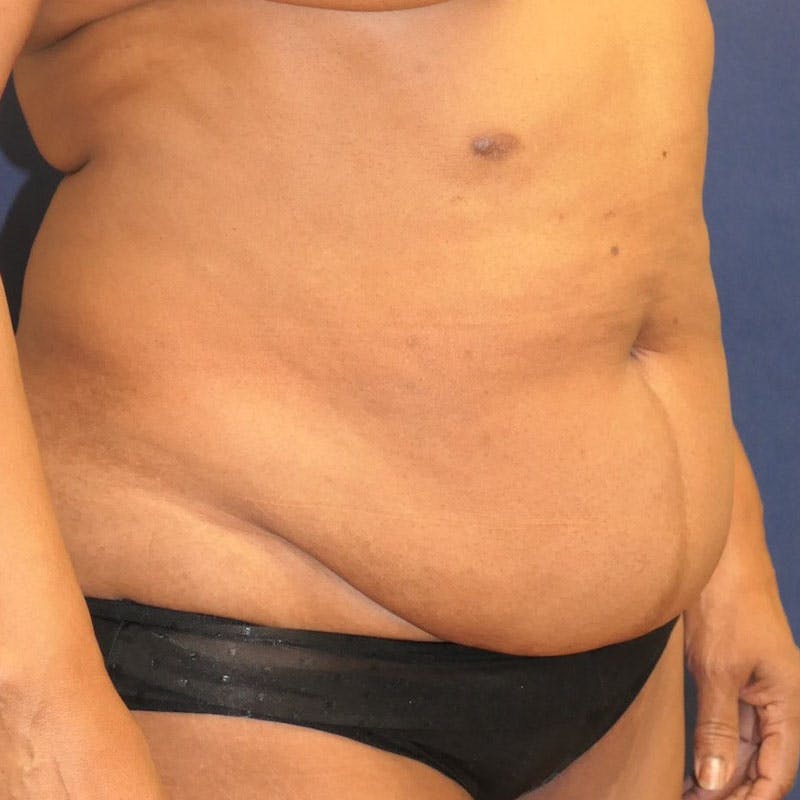 Tummy Tuck (Abdominoplasty) Before & After Gallery - Patient 162150 - Image 3