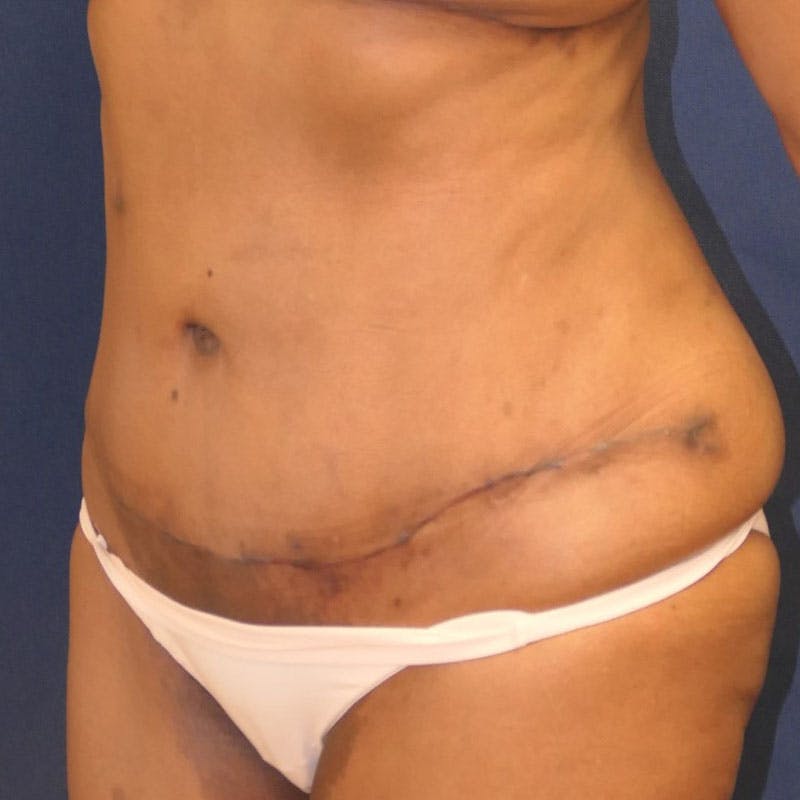 Tummy Tuck (Abdominoplasty) Before & After Gallery - Patient 162150 - Image 10