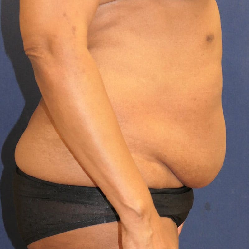 Tummy Tuck (Abdominoplasty) Before & After Gallery - Patient 162150 - Image 5