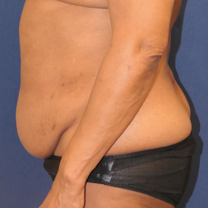 Tummy Tuck (Abdominoplasty) Before & After Gallery - Patient 162150 - Image 7